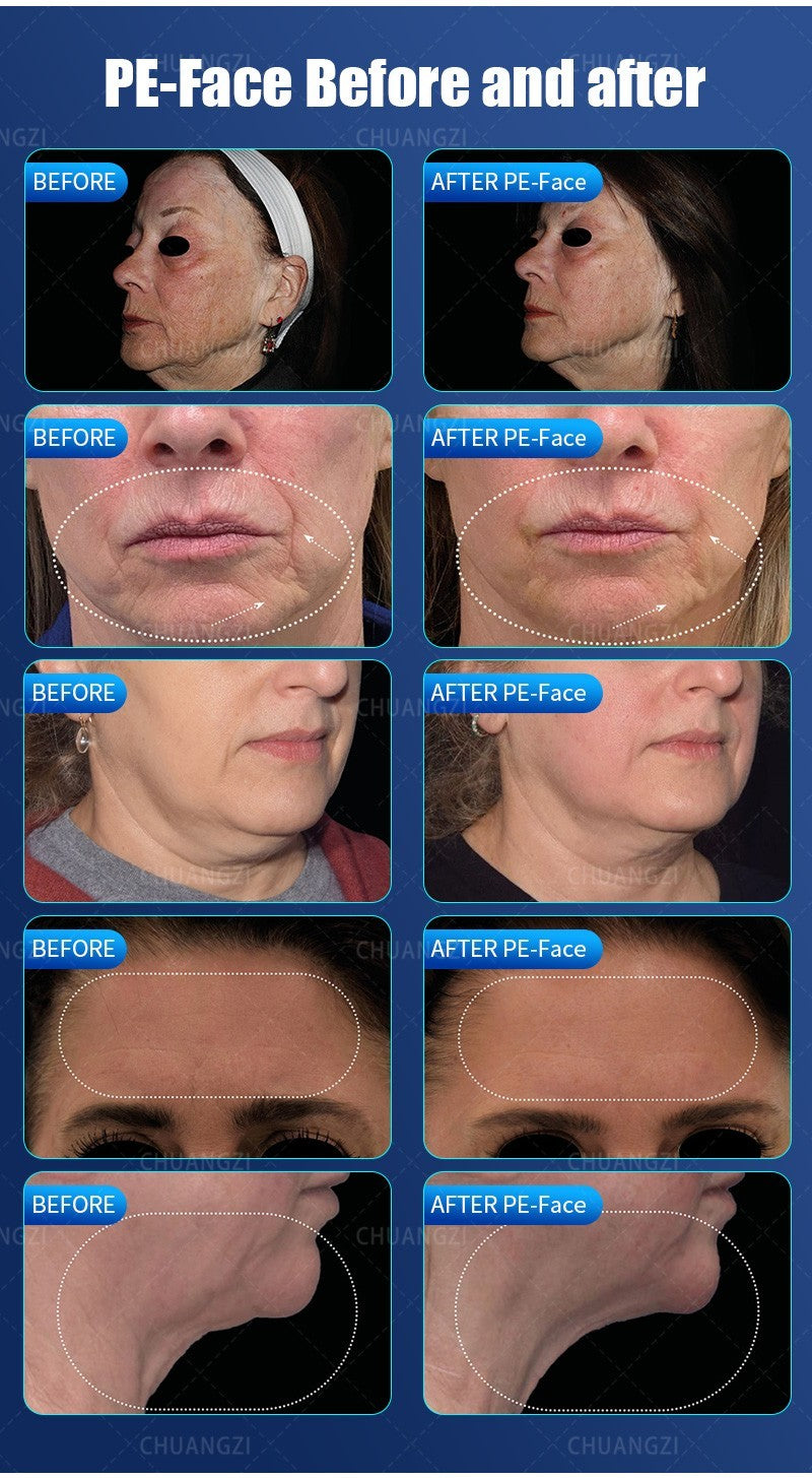 Non-invasive Face Lift Facial Skin Tighten Lifting Machine Wrinkle Reduction SPA